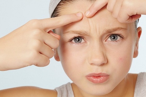 Vị trí mọc mụn trứng cá hé lộ tính cách của bạn